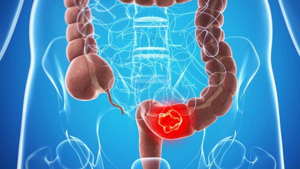 Sau phẫu thuật ung thư trực tràng, tinh hoàn teo dần và “chuyện chăn gối” sa sút