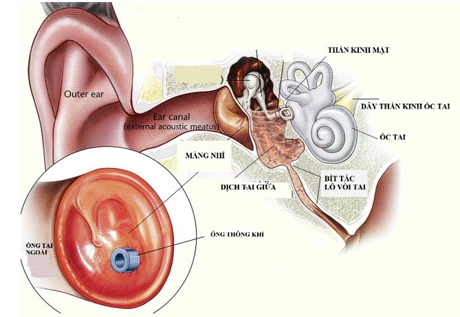 Đặt ống thông khí có tác dụng gì trong viêm tai giữa?
