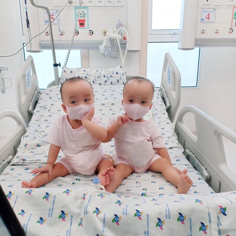 loving photos show conjoined twins after removal of leg cast picture 1