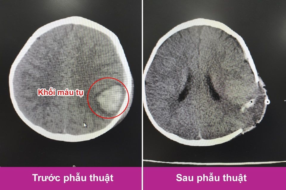 truot chan nga, be trai 11 thang tuoi bi keo dam gay xuat huyet nao hinh anh 1