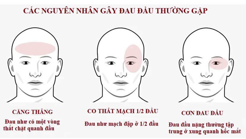 lam gi khi bi dau dau hinh anh 1