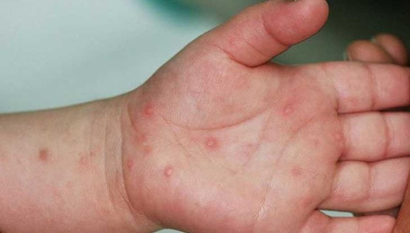hanoi sees sharp rise in cases of hand-foot-mouth disease picture 1