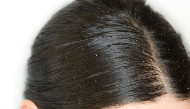 4 nguyên nhân dẫn đến bết tóc ở nam giới mà bạn nhất định phải biết