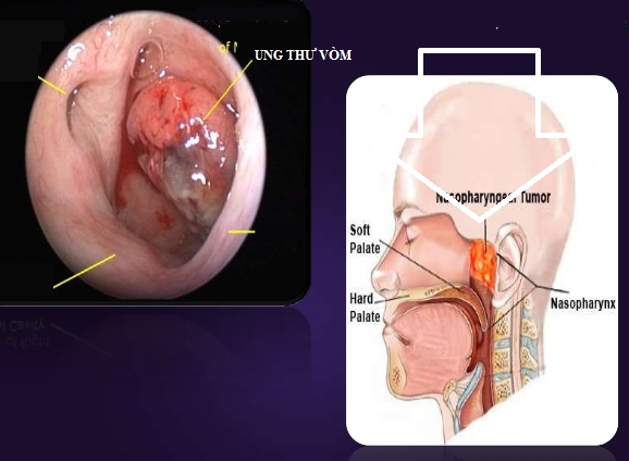 3. Triệu Chứng Kèm Theo Khi Xì Mũi Ra Cục Máu Đông