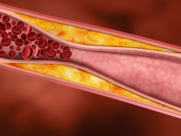 Nồng độ cholesterol cao: Xơ cứng động mạch là tình trạng bệnh khi cholesterol, chất béo và canxi tích tụ thành mảng làm thu hẹp các động mạch. Điều này làm giảm lượng máu lưu thông đến các chi, gây cảm giác lạnh cóng chân.