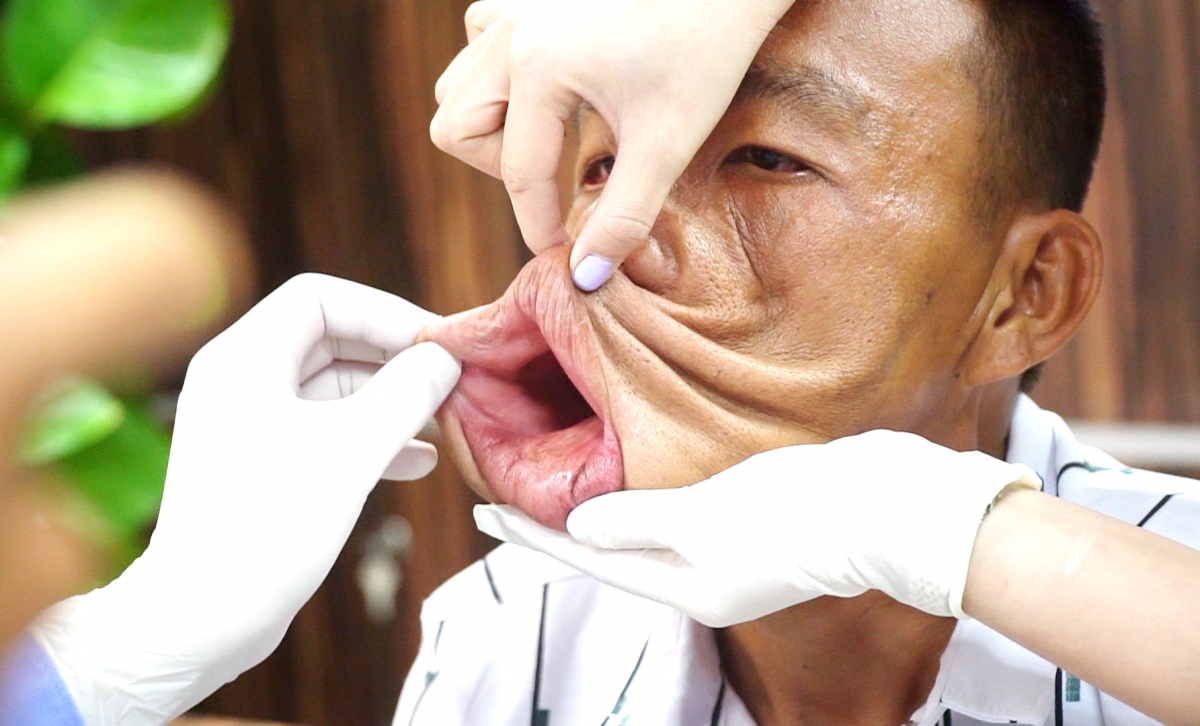 Người đàn ông 15 năm mang khuôn mặt quỷ những ngày đầu chưa phẫu thuật