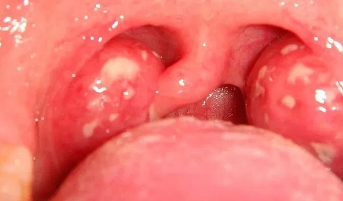 Bệnh thấp tim: Biến chứng nguy hiểm của viêm họng do liên cầu khuẩn nhóm A