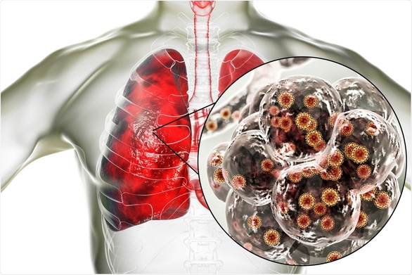 Các hạt li ti của virus SARS-CoV-2 xâm nhập vào phổi. Ảnh: Shutterstock.