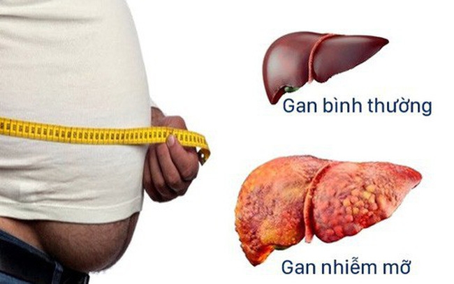 Gan nhiễm mỡ - điều trị thế nào?