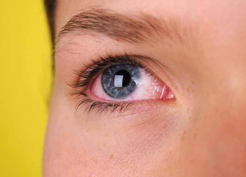 Bệnh khô mắt: Nghiên cứu đã chỉ ra mối liên kết giữa bệnh khô mắt và ô nhiễm không khí. Các chuyên gia về mắt cho rằng các triệu chứng như sợ ánh sáng hay đau nhức mắt mãn tính là do phản ứng viêm miễn dịch của cơ thể đối với ô nhiễm không khí.