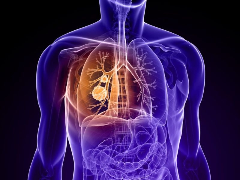 Ung thư phổi: Các chuyên gia đã chỉ ra mối liên hệ chặt chẽ giữa việc tiếp xúc với các khí NOx từ khói bụi phương tiện giao thông với bệnh ung thư phổi.