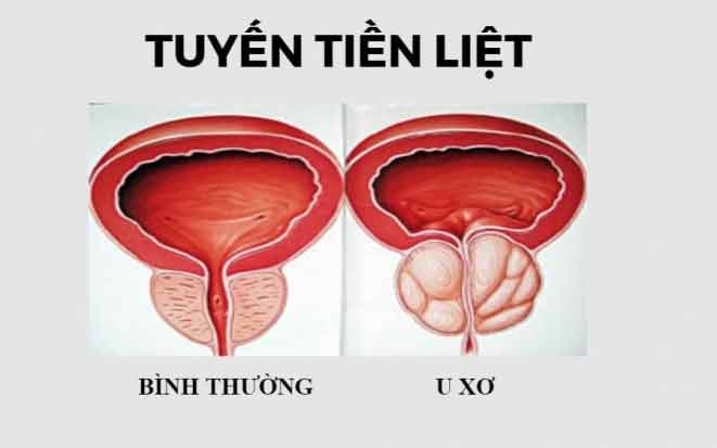 Phì đại tuyến tiền liệt - nỗi ám ảnh của các quý ông