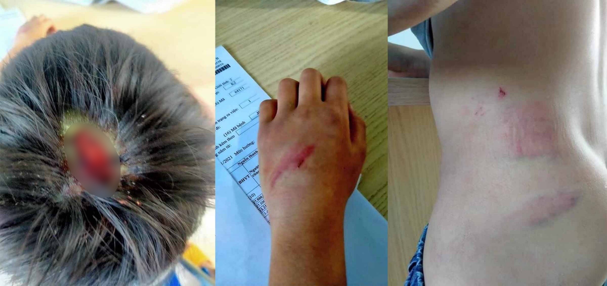 Những vết thương trên cơ thể cháu Boy do hành vi bạo hành của cha để lại.