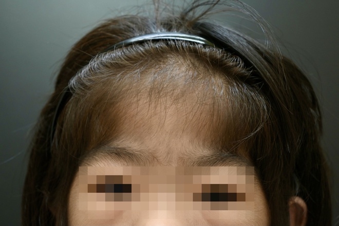 Vietnam confirms two more Cantú syndrome patients