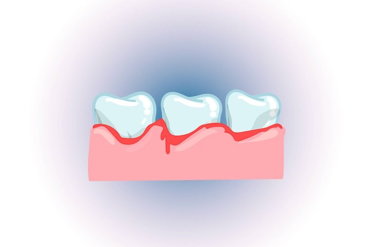 Gây nhiễm trùng nướu: Khi nhai đá lạnh, nướu của bạn rất dễ bị tổn thương do các cạnh cứng và sắc của đá, dẫn đến viêm nướu hoặc nhiễm khuẩn nướu. Thay vì nhai đá, bạn nên ngậm cho đá tan dần hoặc nhai những thực phẩm mềm như kẹo cao su không đường.