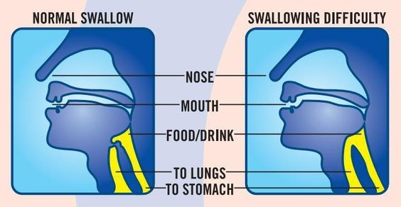 Có thể bạn đã bị rối loạn chức năng nuốt mà không biết!