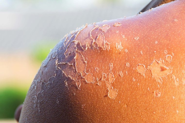 Gãi hoặc bóc lớp da cháy nắng: Việc da bị bong tróc sau khi cháy nắng là một dấu hiệu hoàn toàn bình thường, cho thấy da bạn đang bắt đầu lành lại. Tốt nhất bạn không nên can thiệp vào quá trình chữa lành đó của da và hãy để da bong tróc một cách tự nhiên.