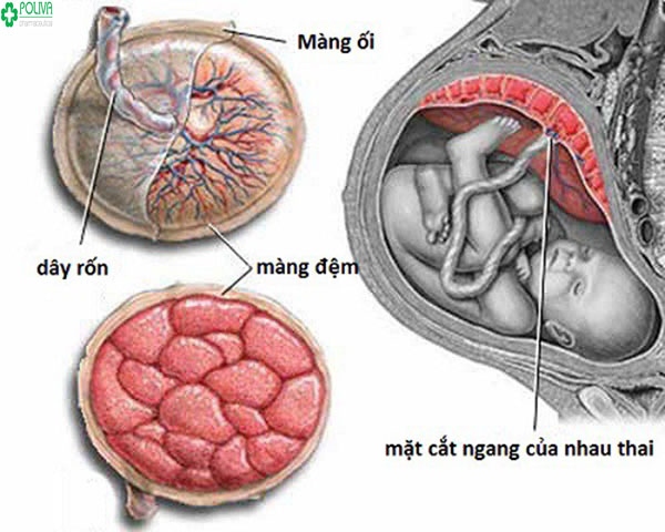 Nguy cơ dây rốn bám màng có ảnh hưởng đến thai nhi