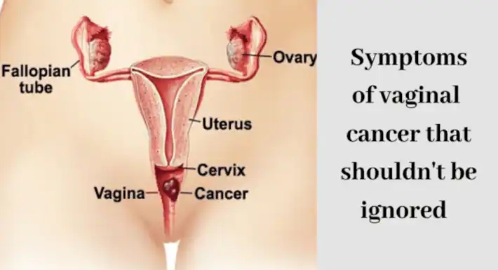 5 triệu chứng không thể bỏ qua của “ung thư âm đạo”