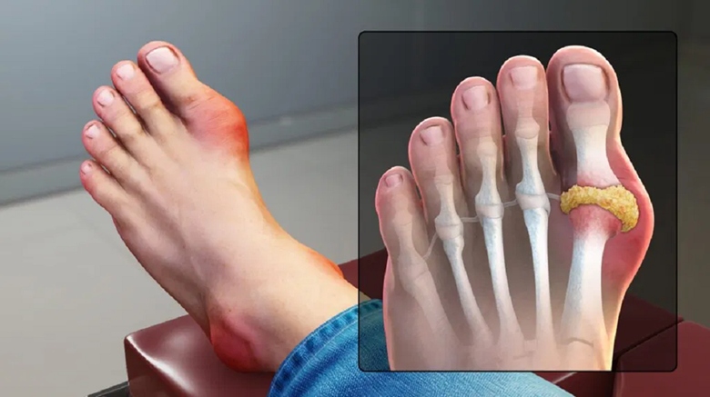 Phân biệt bệnh Gout và bệnh viêm khớp dạng thấp