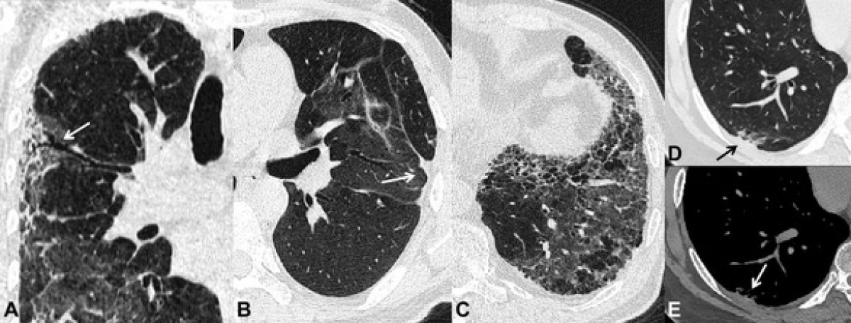  Hình ảnh xơ phổi trên ct : Tìm hiểu về giải pháp điều trị hiệu quả