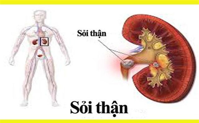 Thói quen uống ít nước, ăn mặn, nhịn tiểu... dễ dẫn đến hình thành sỏi thận.