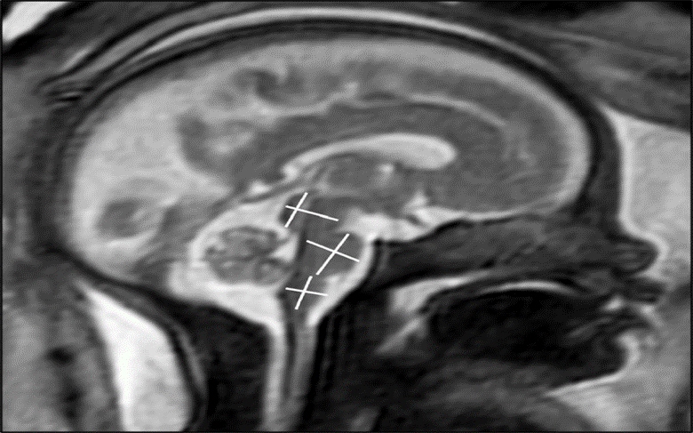 Chụp MRI chẩn đoán sự phát triển não bộ của thai nhi. Ảnh: RSNA và Tiến sĩ Sophia Stöcklein
