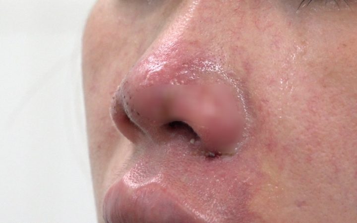 Tình trạng vùng mũi của bệnh nhân L. sau 3 ngày tiêm filler. (Ảnh Bệnh viện Da Liễu TP.HCM cung cấp)