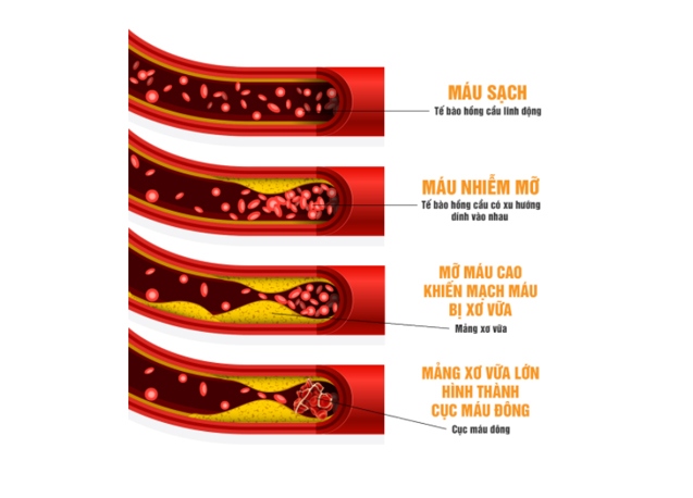 mỡ máu cao: Bí quyết hạ mỡ máu cao cực hiệu quả từ Nhật Bản