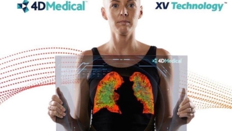 Máy chụp phổi XV 4 chiều hứa hẹn sẽ tạo thuận lợi cho việc khám chữa các bệnh liên quan đến phổi. Ảnh: 9News