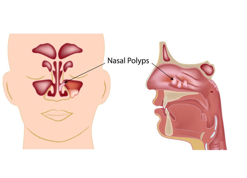 Bị polip mũi, trường hợp nào phải phẫu thuật?