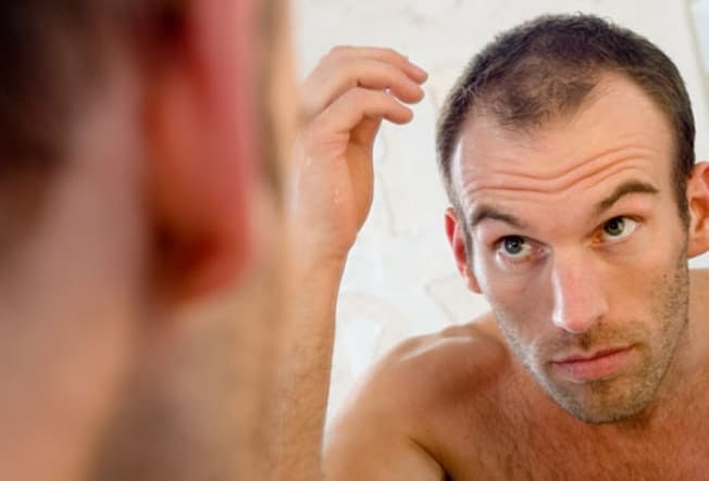 Rụng tóc ở nam giới nguyên nhân do đâu Cách chữa rụng tóc ở nam giới