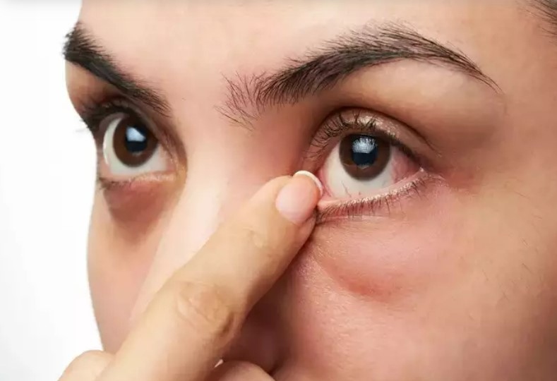 Nguyên nhân phổ biến khiến đôi mắt bạn đỏ ngầu
