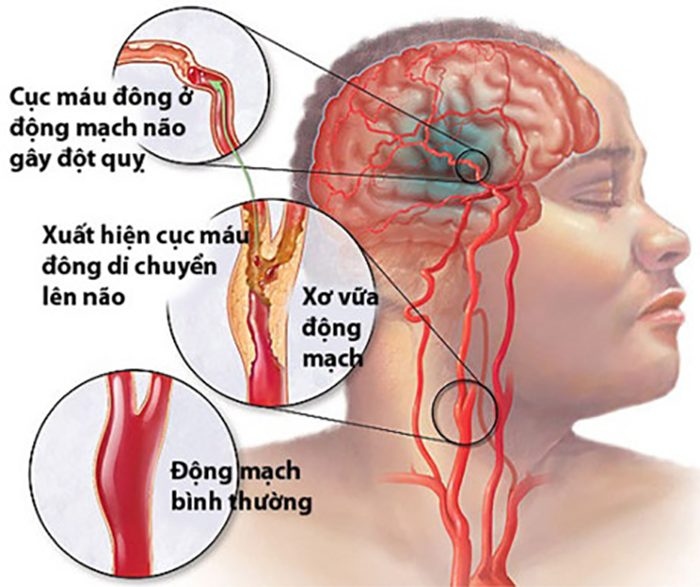 Chảy máu não - biến chứng nguy hiểm của sốt xuất huyết