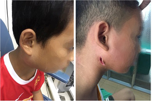 Three Whitmore’s disease cases detected in Vietnam