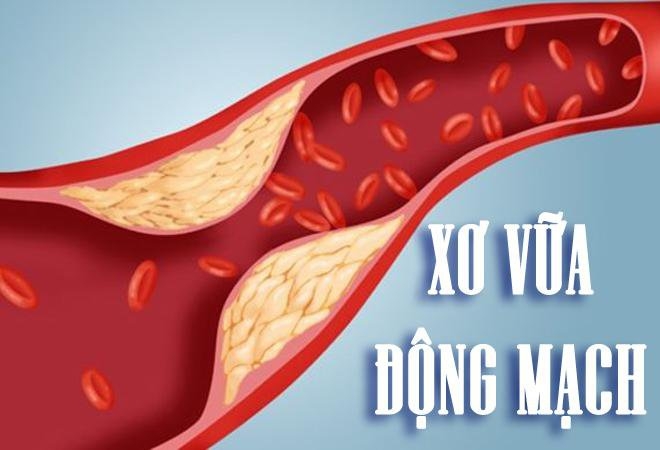 Vì sao nhiều người trẻ bị xơ vữa động mạch?