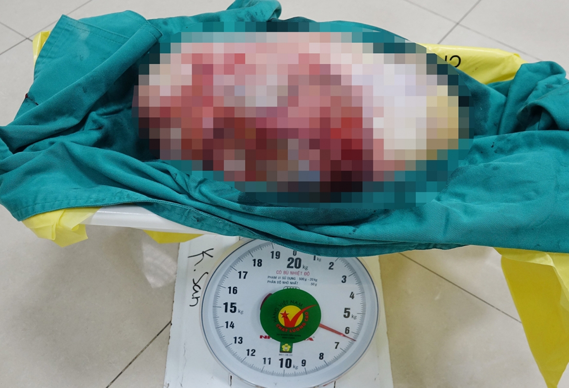 Cắt khối u hơn 6kg trong bụng cô gái 28 tuổi