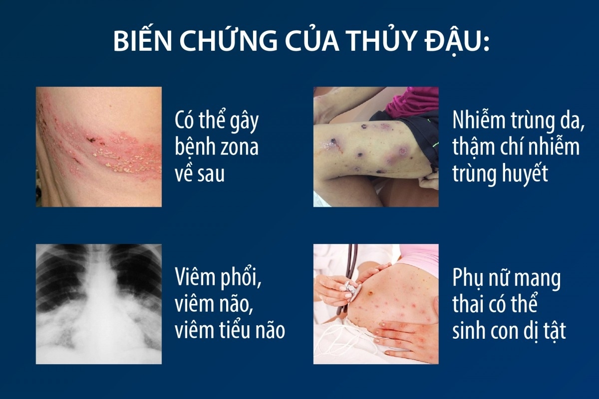 Bệnh thủy đậu bùng phát ở Hà Nội: Chuyên gia khuyến cáo cách phòng ...