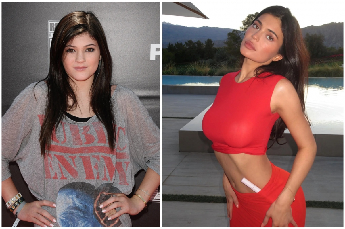 Kylie Jenner bị chỉ trích nói dối khi tuyên bố không phẫu thuật thẩm mỹ