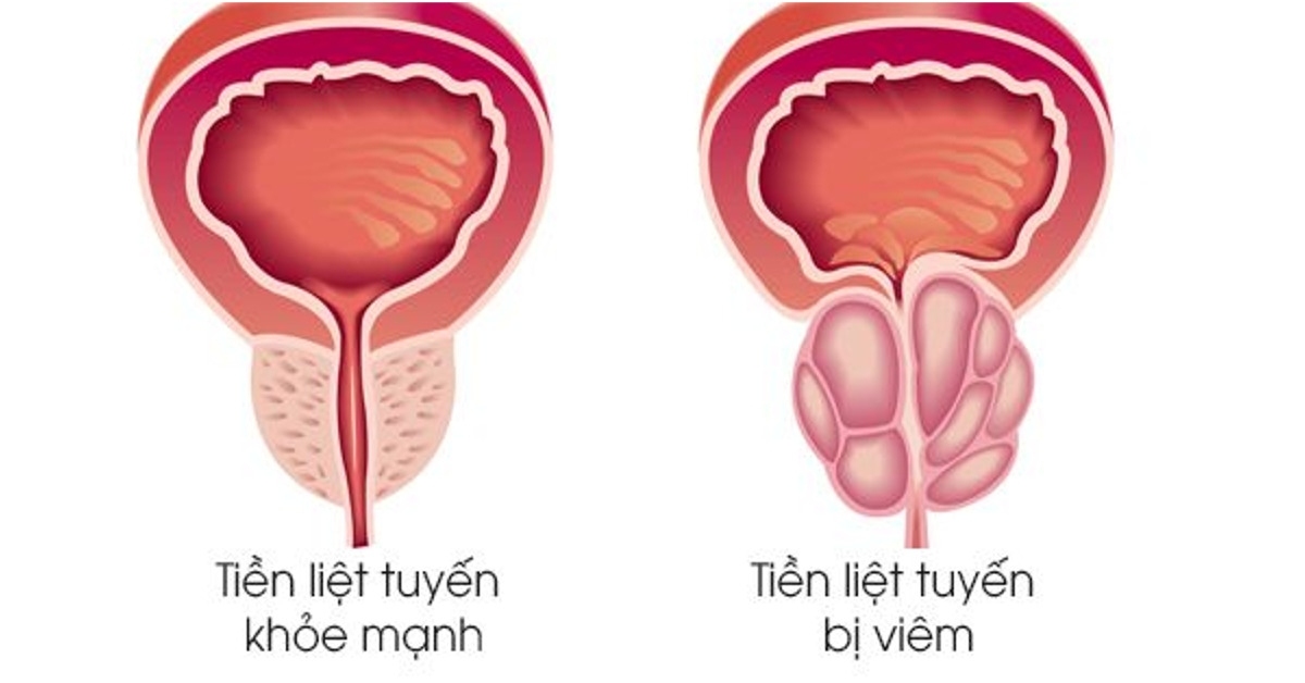 Người trẻ có bị tiền liệt tuyến?