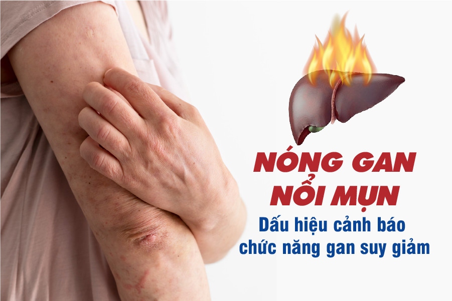 Nóng gan nổi mụn - Dấu hiệu bệnh lý gan mật, đừng xem thường