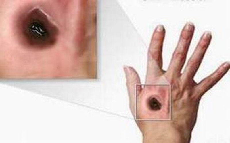 Những điều cần biết về bệnh than