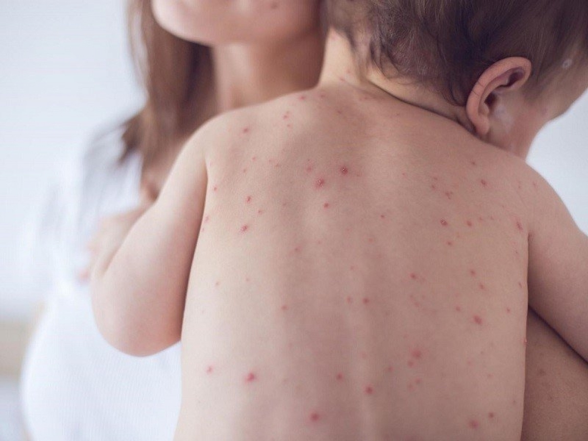 doctors warn of abnormal rise in chickenpox cases this summer picture 1