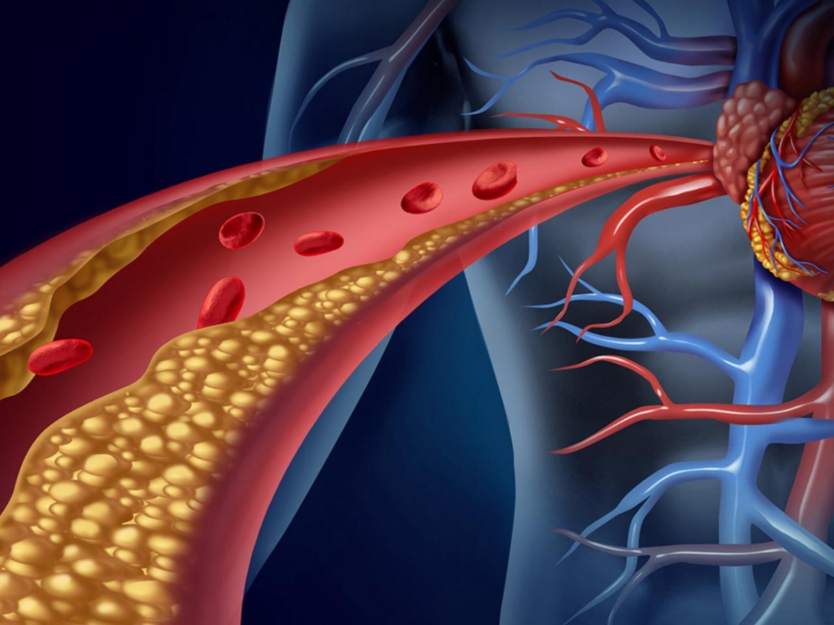 dau hieu cholesterol cao lo ro tren guong mat, dung bo qua hinh anh 1