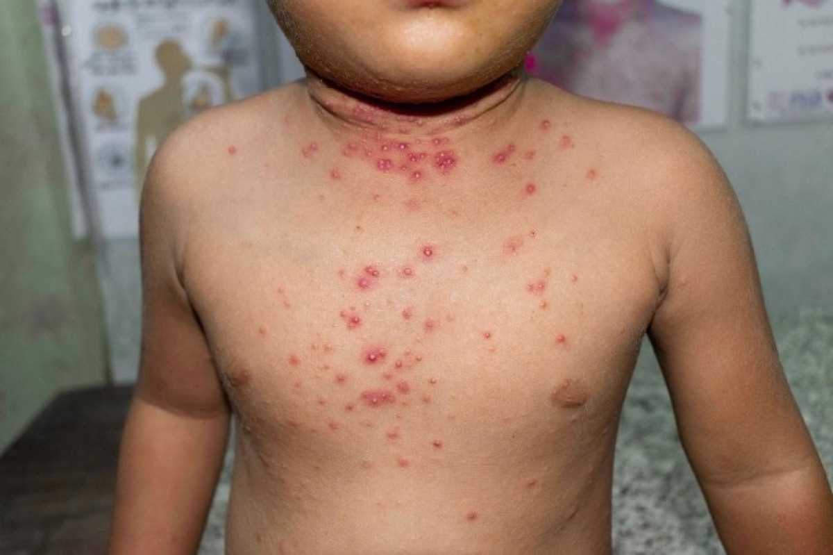 vietnam records four monkeypox cases picture 1