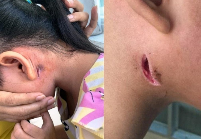Health ministry issues Whitmore disease warning after teen death