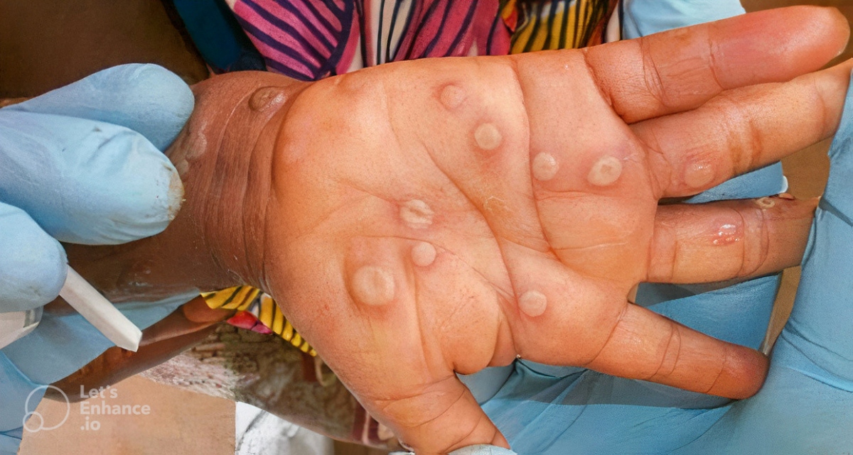 southern dong nai province logs second monkeypox infection picture 1