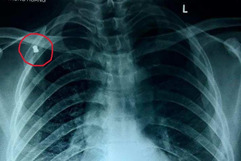 Người đàn ông đang làm rẫy bị trúng "đạn lạc"