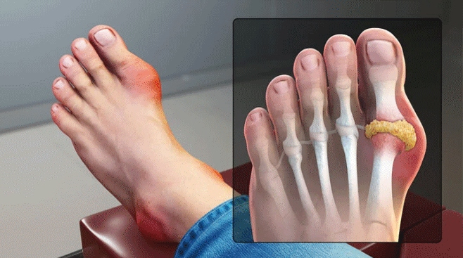 Bệnh gout có xu hướng trẻ hóa, bác sĩ chỉ cách phòng ngừa