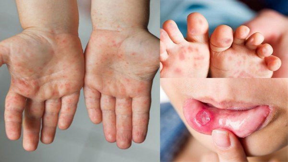 Vietnam ensures sufficient supply of HFMD medications
